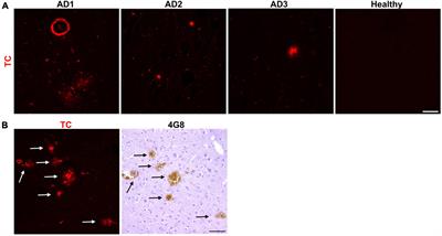 Identification of Multicolor Fluorescent Probes for Heterogeneous Aβ Deposits in Alzheimer’s Disease